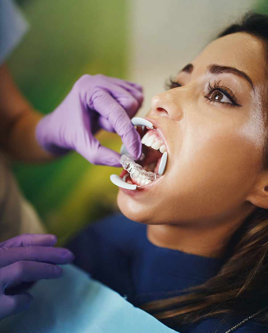 Clear Aligners in Kolkata | Orofacial Polyclinic  Clear Aligners in Kolkata | Orofacial Polyclinic