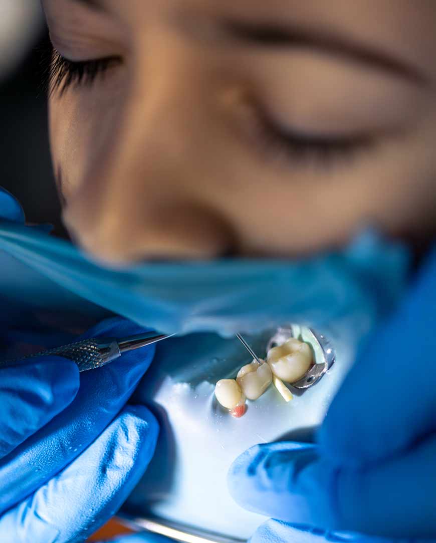 Wisdom Teeth Removal in Kolkata | Orofacial Polyclinic  Wisdom Teeth Removal in Kolkata | Orofacial Polyclinic